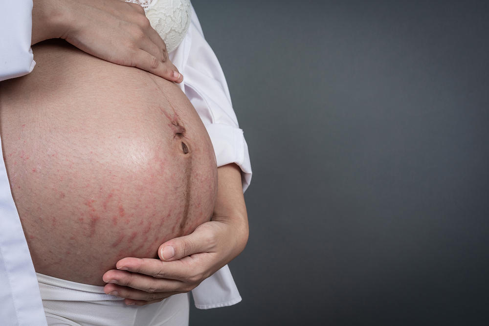 受保護的內容: 【孕婦皮膚問題】妊娠紋、痤瘡、瘙癢…5大常見問題該如何預防與修復?